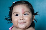 Birthmarks 101 – What You Need to Know - U.S. Dermatology Partners