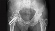 Osteosíntesis en cadera | Dr. Josué Calderón Gamba