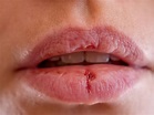 Busted Lip Treatment: How To Care For Lip Laceration | St. John's Health