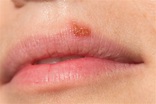Lip Herpes | The Art Of Beauty