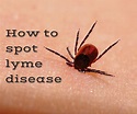 Ticks and Lyme Disease - Know The Symptoms of Lyme Disease