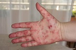 Hand, foot and mouth disease is highly contagious — this is how to ...