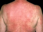 How Long Does A Drug Reaction Rash Last | Allergy Differences