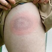 Signs and Symptoms of Lyme Disease · ExtermPRO