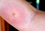 What does a spider bite look like pictures and symptoms