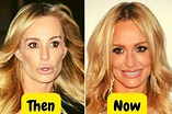 Taylor Armstrong Before Plastic Surgery: Which Cosmetic Surgery Has She ...