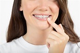 【箍牙價錢2023】透明牙箍、傳統箍牙分別！Zenyum、Beame、隱適美透明牙箍價錢、療程比較！ | ELLE HK