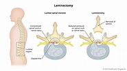 Laminectomy | Gleneagles Hospital