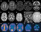 Fatal insomnia - Wikipedia