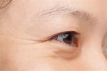 [去眼紋指南] 回復眼周肌膚緊緻度： 減淡眼紋必看！ | Perfect Medical