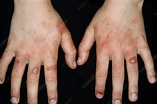 Streptococcal rash on the hands - Stock Image - C013/0847 - Science ...