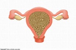 Mola Hidatiforme (Gravidez Molar): o que é, Tratamento e Mais | Saúde ...