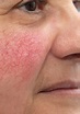 Facial Veins & Redness – Laser and Skin Clinics