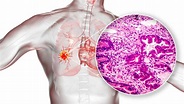 Saiba o que é o adenocarcinoma pulmonar – Quimioclinic
