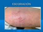 Lesiones elementales de la piel