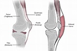 Prepatellar (Kneecap) Bursitis - OrthoInfo - AAOS