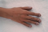 Clubbed Fingers as an Early Sign of Illness - Facty Health