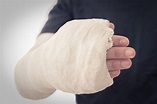 Plaster of Paris – Once a Backbone of Orthopaedics - Bonesurgeon