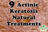 9 Actinic Keratosis Natural Treatments - Healthy Focus