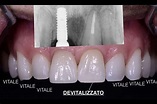 Un dente devitalizzato è pericoloso? - Studio Dentistico Cozzolino