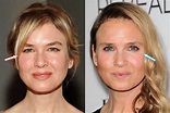 Renee Zellweger Plastic Surgery REVEALED? (Before & After 2018)