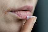 How to heal a busted lip? What to do for Mouth Injuries- st.John's Health
