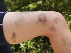 Causes of Easy Bruising: Reasons Why People Bruise Easily | Health ...