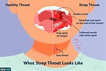 Everything You Need to Know About Strep Throat | Strep throat, Swollen ...