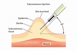 Administering Subcutaneous Injections | Ausmed