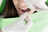 Devitalizzare un dente - Centro di Odontoiatria e Stomatologia F. Perrini