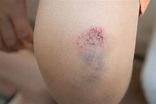 Abnormal Bruising In Children: Signs, Causes And Treatments | MomJunction