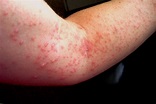 sunscreen allergic reaction - pictures, photos