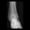 Salter-Harris Fracture | Pediatric Radiology Reference Article ...