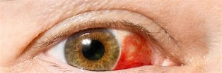 Ojo rojo (Explicación de cuidados y tratamiento) | Clínica ...