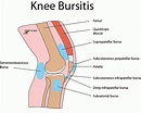 Knee Bursitis - Mississauga and Oakville Chiropractor and Physiotherapy ...