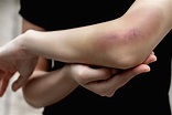 What Are Serious Bruises and How Can I Treat Them? | Performance Health