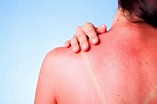 Crema para quemaduras del sol : ¿Cuál escoger? - Skinexpert