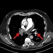 CT pulmonary angiography (CTPA) showinga bilateral pulmonary embolisms ...