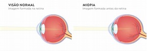 Graus de miopia. Como saber o seu? | Lenscope