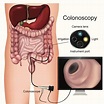 What to Expect When You Have a Colonoscopy - THE IBS DIETITIAN