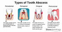 Periodontal Abscess: Symptoms, Causes & Treatment - Share Dental Care ...
