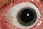 La mydriase traumatique et déchirures de l'iris - Ophtalmologie