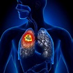 8 síntomas del cáncer de pulmón que puedes detectar temprano | Bioguia