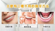 陳澔賢醫生 - 傳統牙箍vs隱形牙箍點揀好？箍牙箍一世？牙醫解答4個箍牙迷思