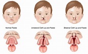 Cleft Lip and Cleft Palate | Vikram ENT Hospital