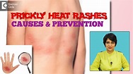 Prickly Heat Summer Rash- Know the Causes & Tips to prevent it? - Dr ...