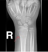 The Pediatric Wrist Buckle Fracture is Common - Louisville Bones