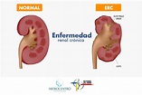 Nefrocentro - Cuidado Integral del pacientes renales