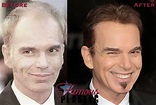 Billy Bob Thornton Plastic Surgery Facelift, Hairplug Before and After