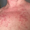 6 details about sun allergy, polymorphic or polymorphous light eruption